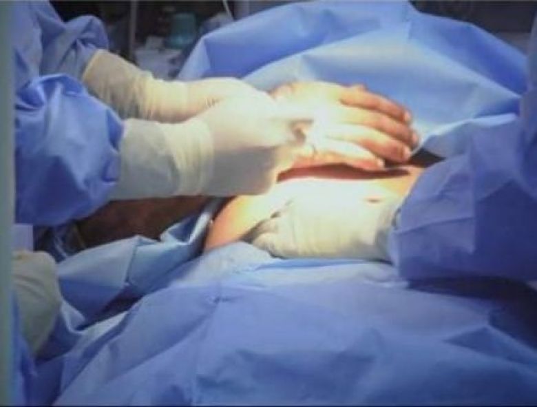 في عملية نادرة.. جراح كربلائي يزرع يد مُصاب داخل بطنه (بالصور)
